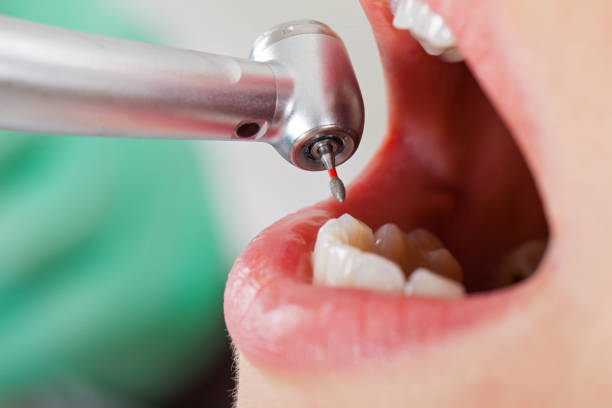 Best Emergency Broken Tooth Repair in Clemson, SC